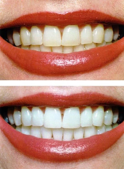 before and after photos of Flossy Smiles' teeth whitening procedure