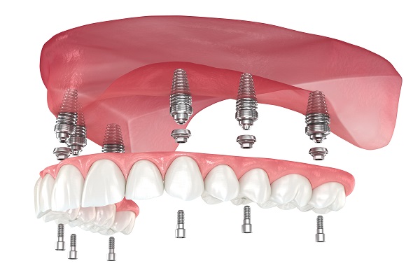 Advantages And Drawbacks Of Implant Supported Dentures