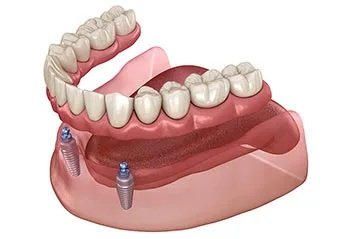 Overdentures